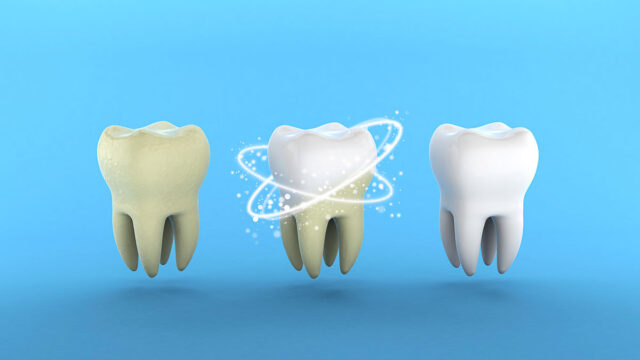 teeth whitening tooth with tartar after rrrrray whitening blue background 3d render
