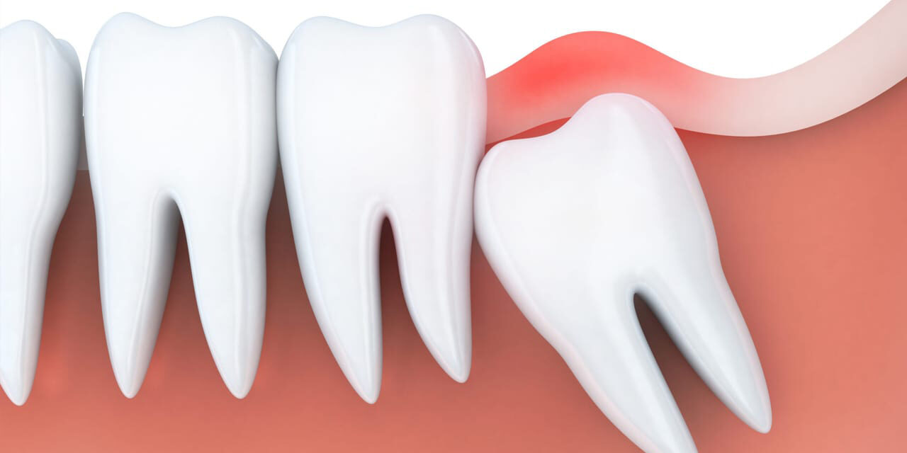 Yirmilik Diş Çekimi & İyileşme Süreci