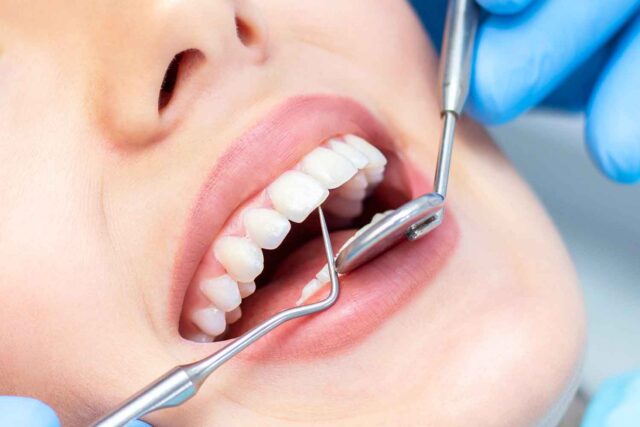 Yirmilik Diş Tedavisi