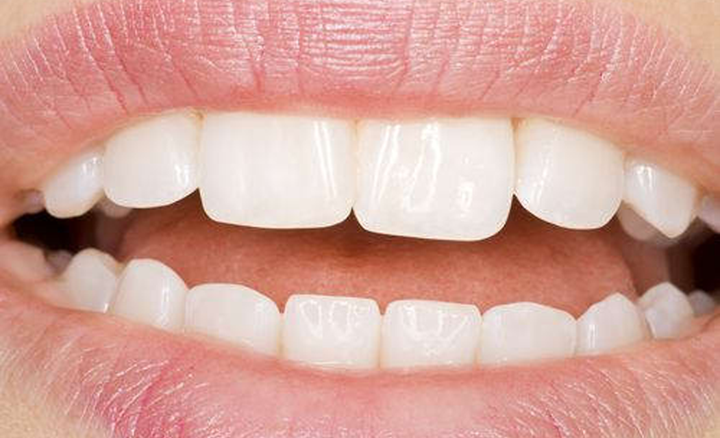 Diş Ucu Nasıl Oluşur ? konya Diş Ucu Tedavisi