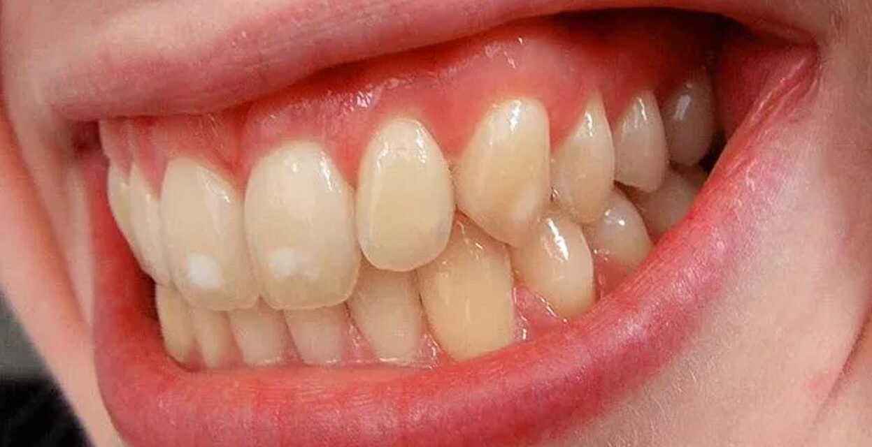 Dişteki Beyaz Lekeler / Konya Dişteki Beyaz Leke Tedavisi
