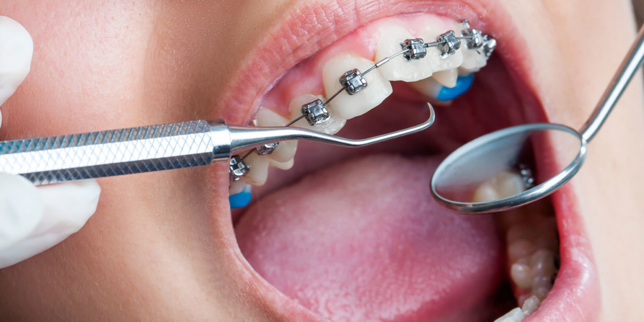 Ortodonti Tedavi Süreci Nasıl İşler ? / Konya