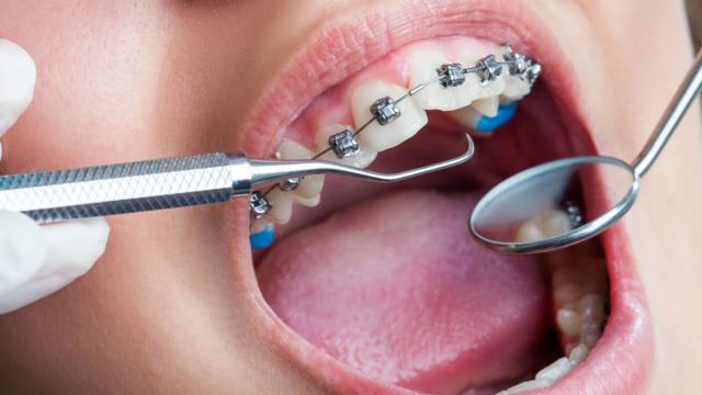 ortodonti tedavisi 