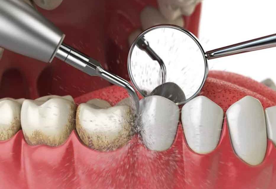 Diş Taşı Temizliği Nedir ?