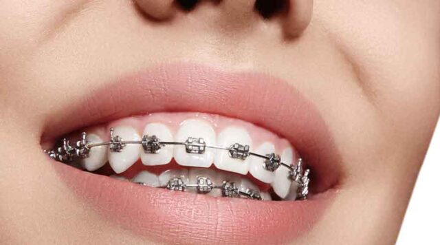 Konya ortodonti tedavisi 