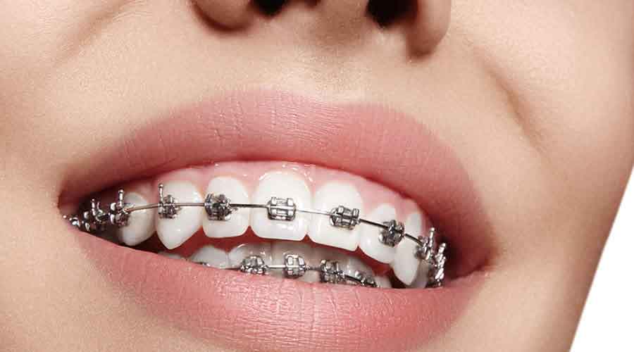 Ortodonti Tedavisi Nedir ?