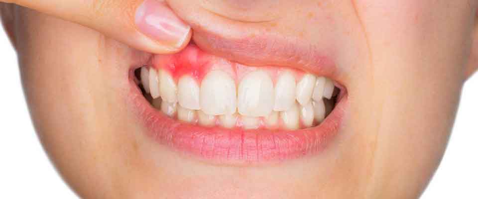 Diş Eti Enfeksiyonuna Ne İyi Gelir ?
