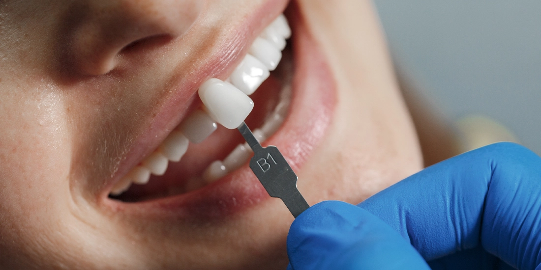 E-Max Kaplama ve Zirkonyum Kaplama: İki Farklı Estetik Dental Restorasyon Yöntemi