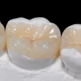 Onlay Dolgu: Diş Hekimliğindeki Önemli Restoratif Tedavi Yöntemi