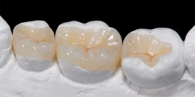 Onlay Dolgu: Diş Hekimliğindeki Önemli Restoratif Tedavi Yöntemi