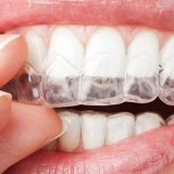 Şeffaf Diş Plağı Tedavi Süreci: Estetik Yaklaşım