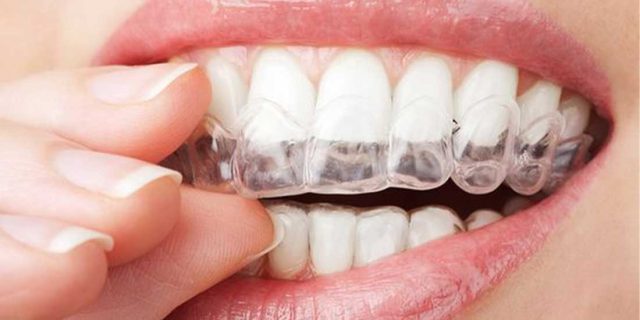 Şeffaf Diş Plağı Tedavi Süreci: Estetik Yaklaşım